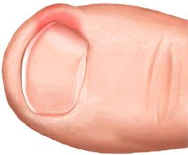 Хірургічне видалення врослого нігтя в Житомирі